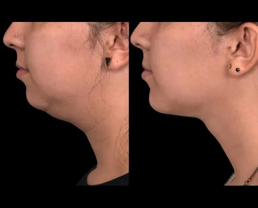 Patient Testimonials: Best Doctors in Dubai for Double Chin Removal