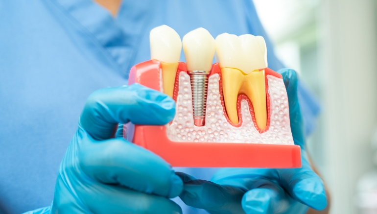 Dental implants in Texas