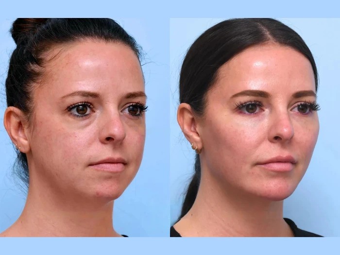 Best Plastic Surgeon in Dubai Perfect Facial Lifting with Thread Lift