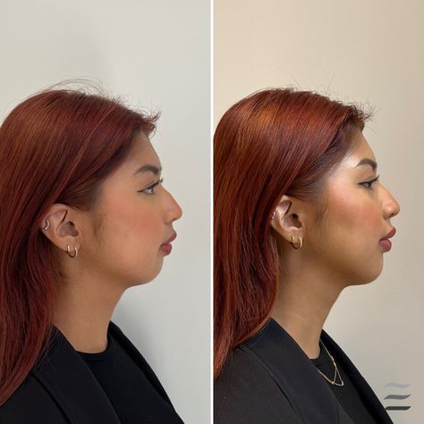 chin Botox treatment results New Lenox IL