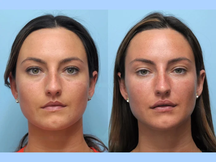 Revitalize Your Skin Naturally with Thread Lift by the Best Plastic Surgeon in Dubai